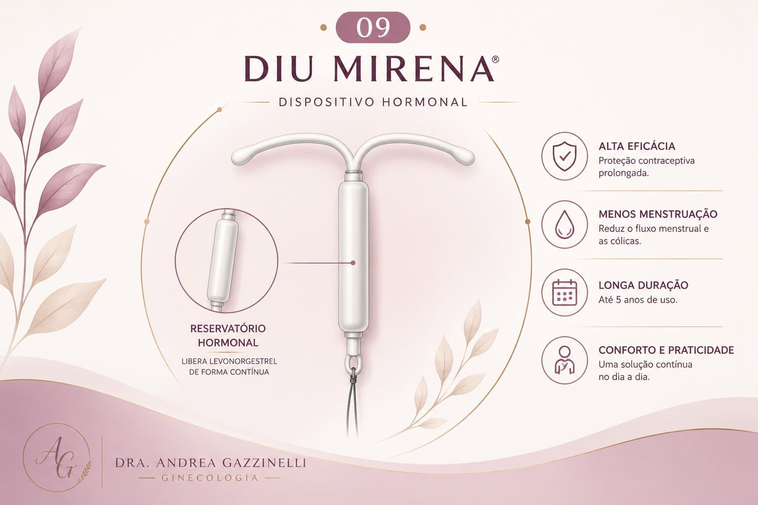 DIU Hormonal 52 mg (Mirena®) — ilustração médica esquemática